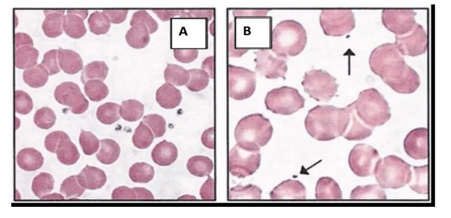 Peripheral blood film of the patient