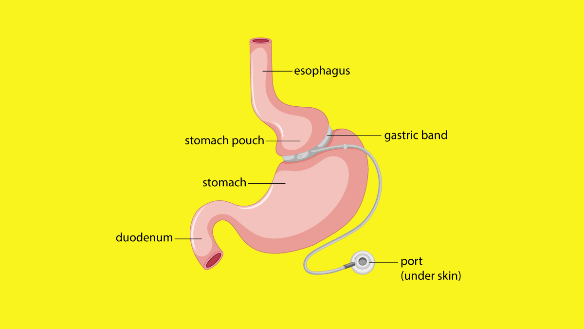 What is Gastric Banding and How it Works
