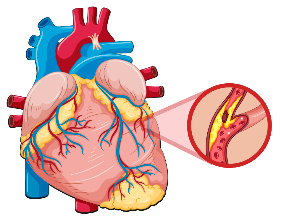 High Cholesterol Leads to Atherosclerosis