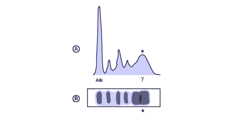 Polyclonal pattern serum SPEP