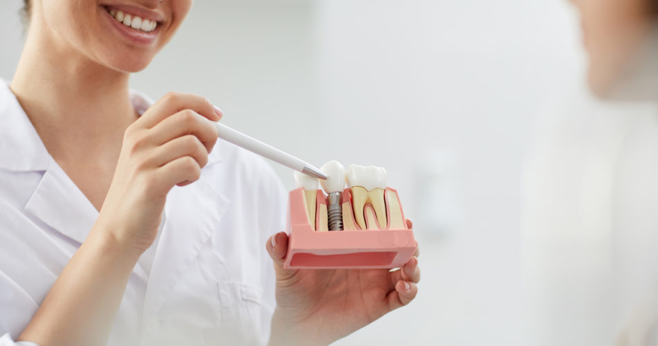 Dental Implants