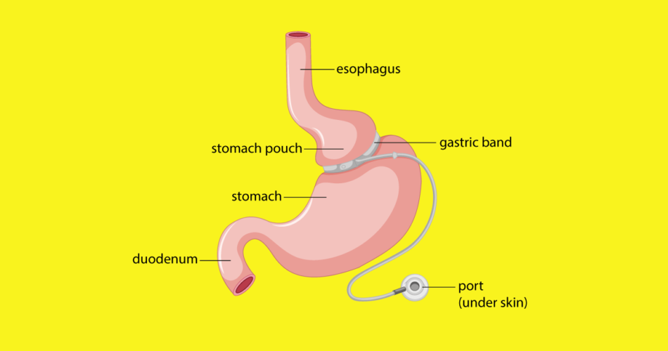 What is Gastric Banding and How it Works