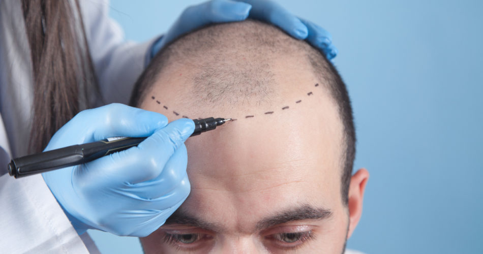 5 Things You Should Know When Considering a Hair Transplant in the UK