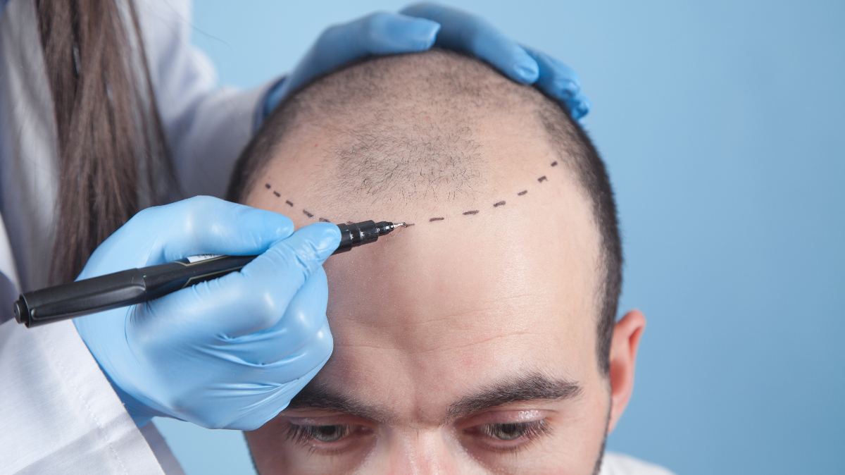 5 Things You Should Know When Considering a Hair Transplant in the UK