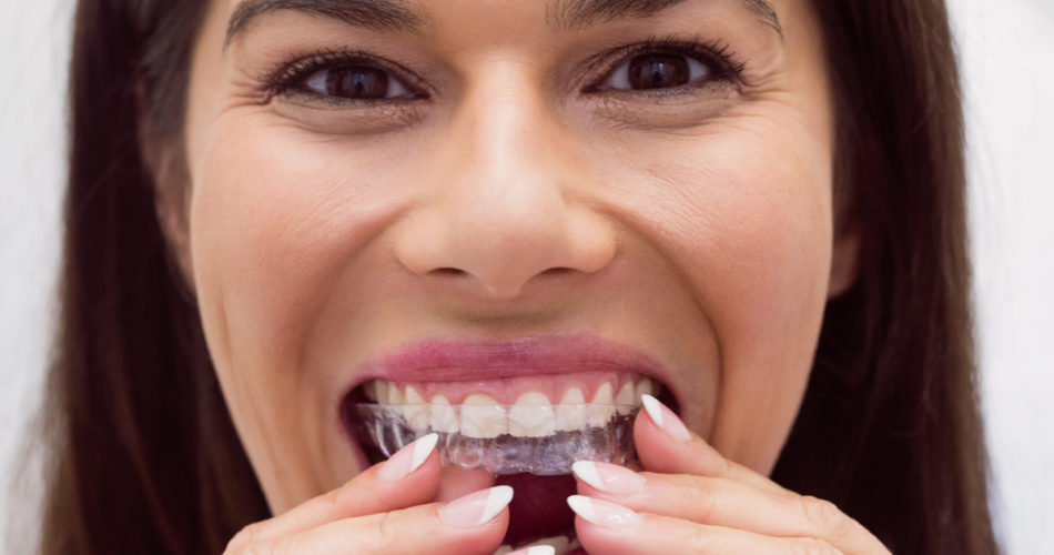 How to Take Care of Your Invisalign Aligners