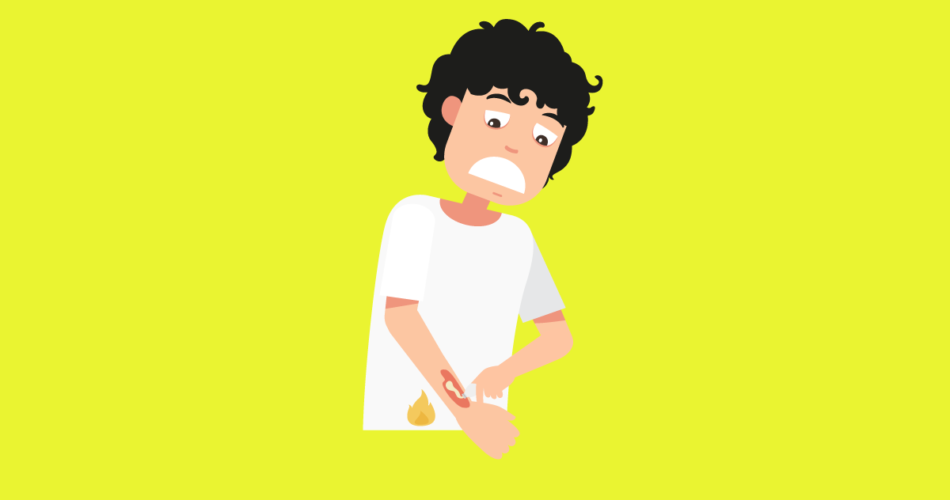 Recently Been Burned? Here's What You Need to Do