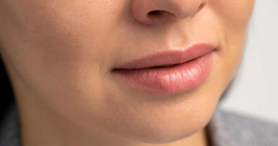 How Long Does Dermal Filler Last in Lips?